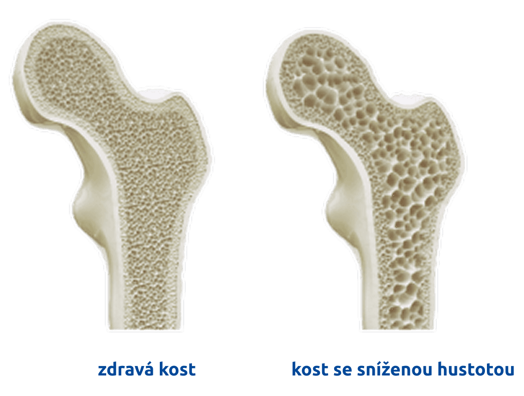 Demineralizace kostí - zdravá vs. kost se sníženou hustotou